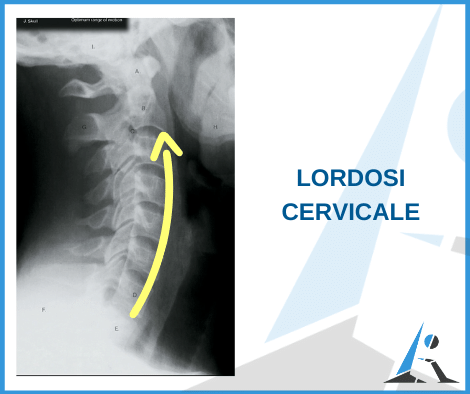 Lordosi cervicale