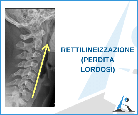 rettilineizzazione del rachide cervicale