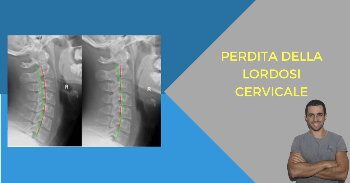 Curare la perdita della fisiologica lordosi cervicale - L'Altra