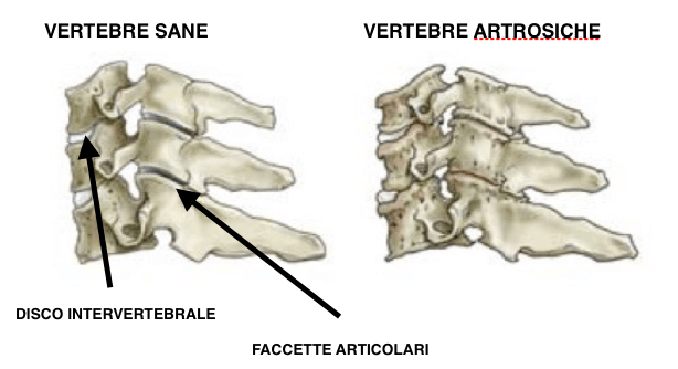 artroza lombara