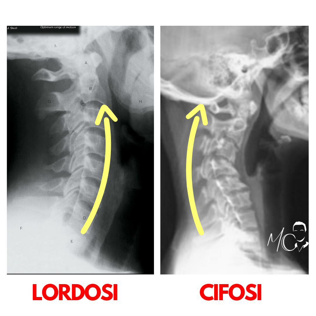 Lordosi o cifosi cervicale