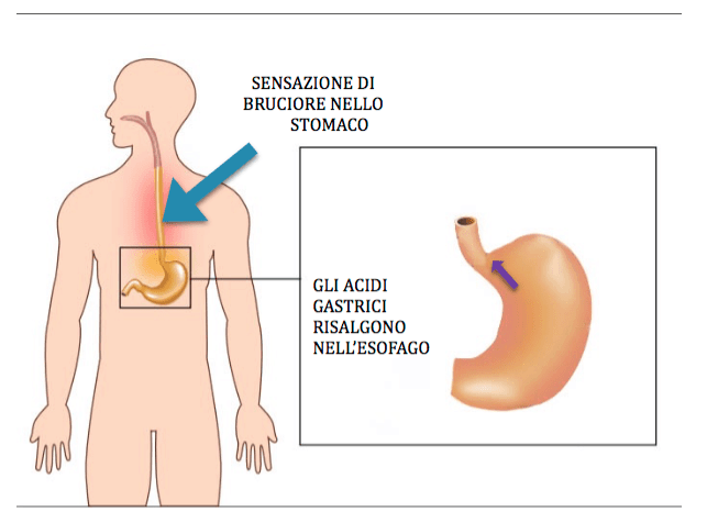 Acidita Di Stomaco 7 Rimedi Per Combatterla L Altra Riabilitazione