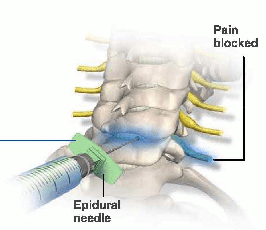 immagine tratta da Google immagini, che illustra una iniezione epidurale