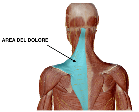 tensione trapezio