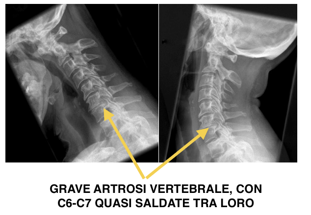 lastra-artrosi-cervicale