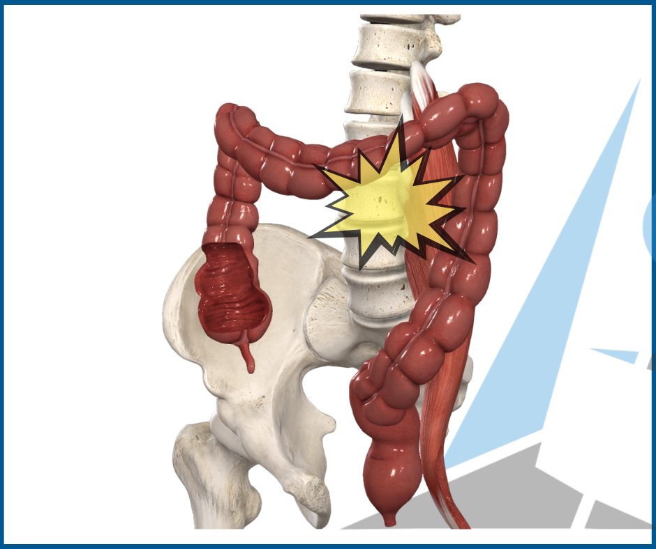 Intestino infiammato e mal di schiena