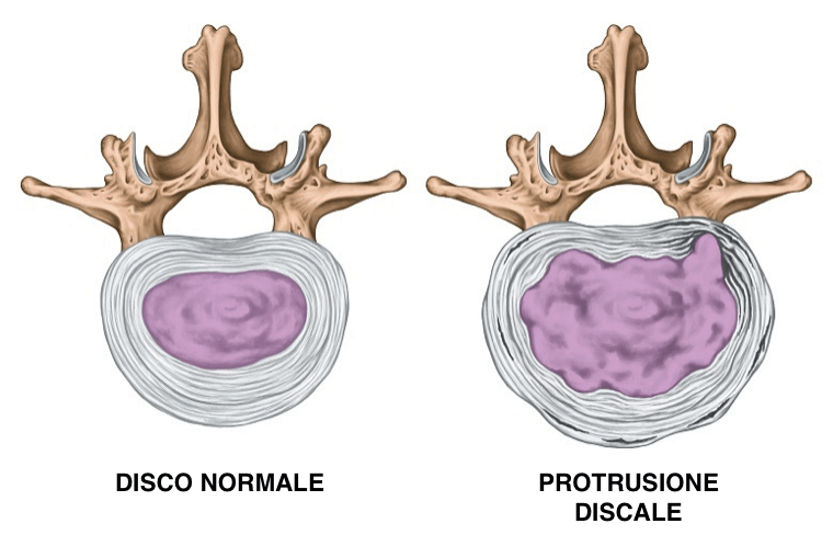 Discopatie e protrusioni cervicali