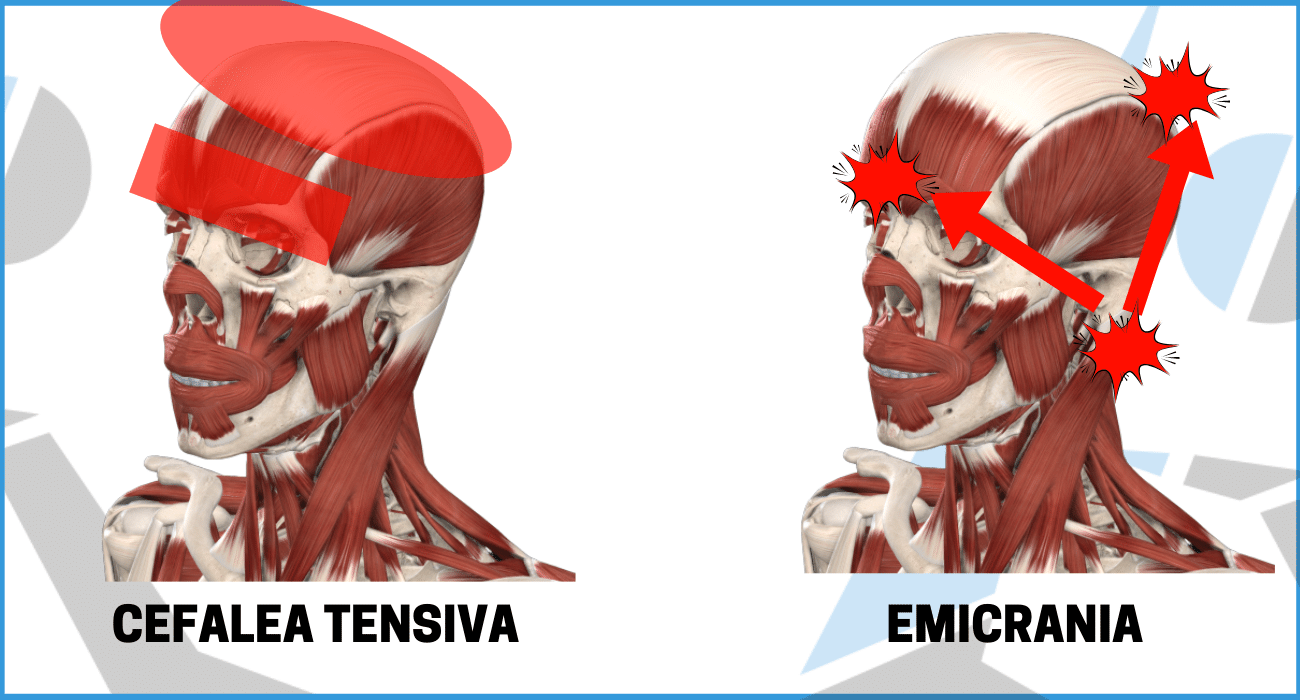 Emicrania cervicale