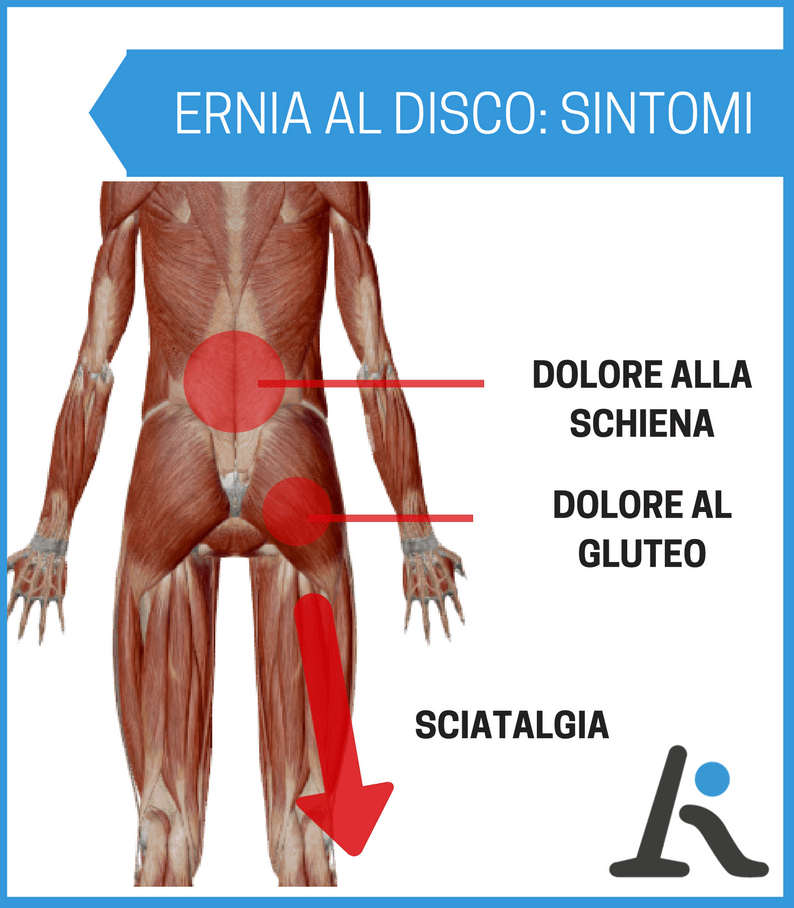 Ernia del disco sintomi