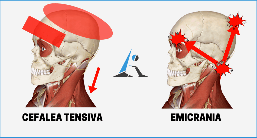 Cefalea muscolo tensiva ed emicrania
