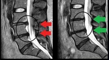 Ernia del disco guarigione spontanea