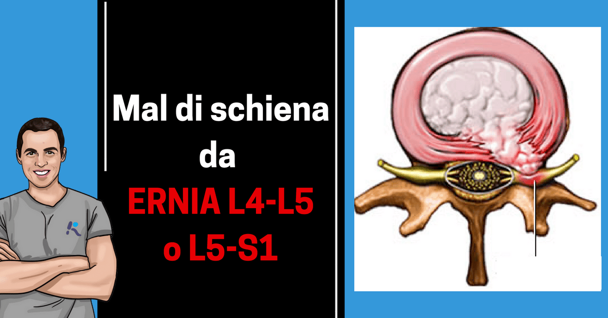 Cosa Fare Per Il Mal Di Schiena Da Ernia Del Disco L4 L5 O L5 S1 L Altra Riabilitazione