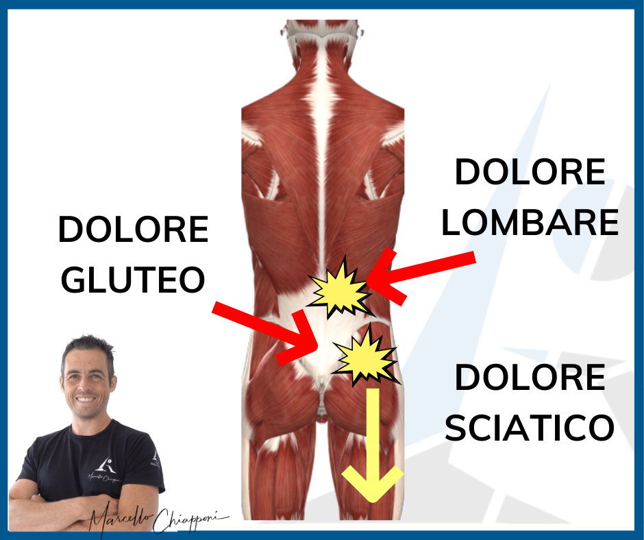 Lombosciatalgia sintomi