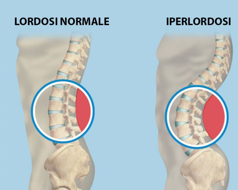 ipolordosi e iperlordosi lombare