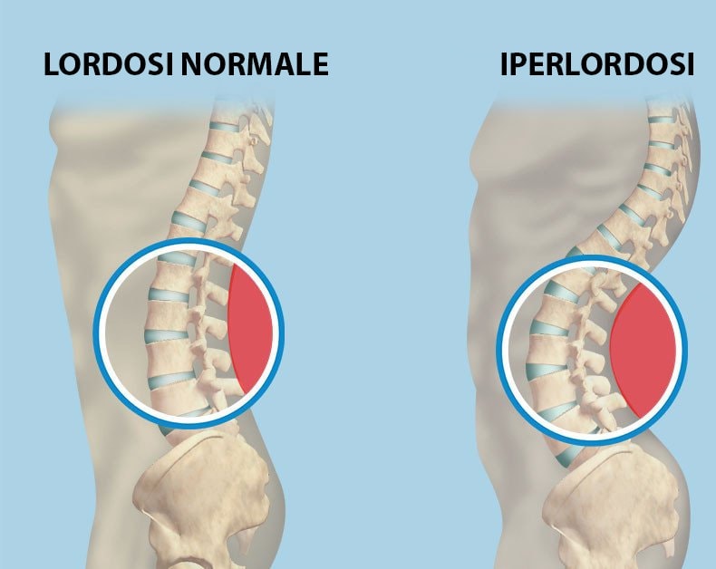 Esercizi per ileo psoas: il muscolo che infiamma schiena e anca