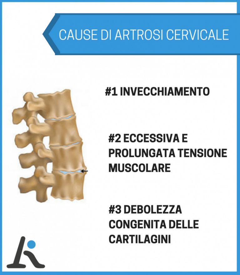 Cause di artrosi cervicale