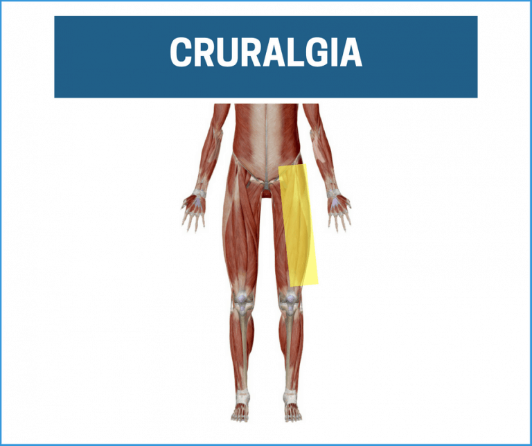 cruralgia