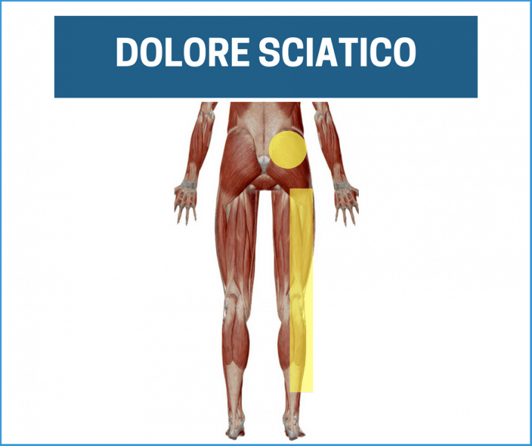 dolore sciatico