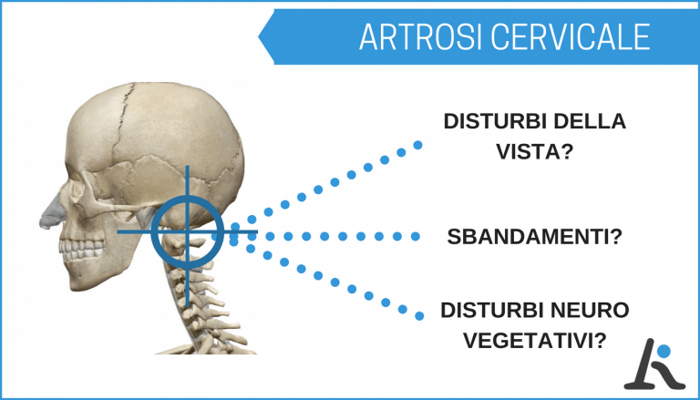 Sintomi artrosi cervicale: disturbi alla vista, sbandamenti e disturbi neuro-vegetativi