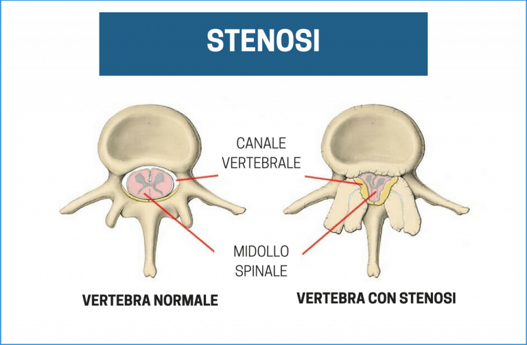 Stenosi