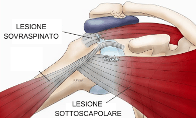 periartrita scapulohumerala cod diagnostic