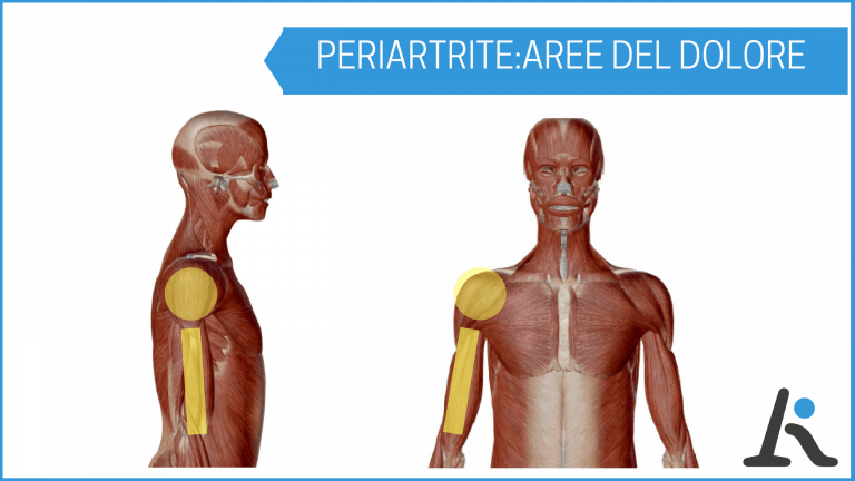 periartrite cronica semplice