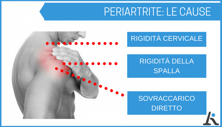 periartrite cronica semplice