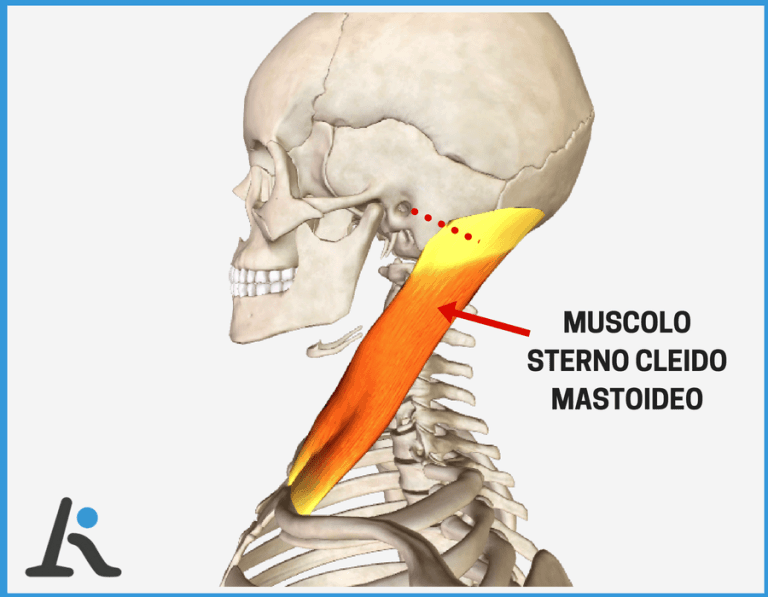 Acufeni cervicale e muscolo sternocleidomastoideo