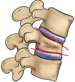  schiacciamento vertebrale traumatico