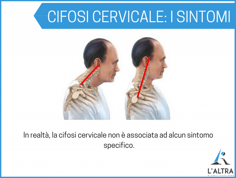 Cifosi cervicale sintomi