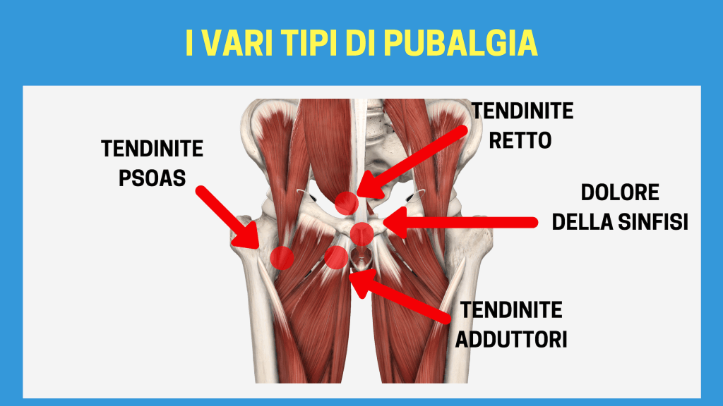 pubalgia