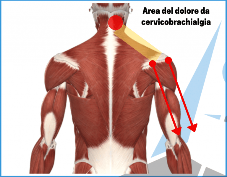 Cervicobrachialgia