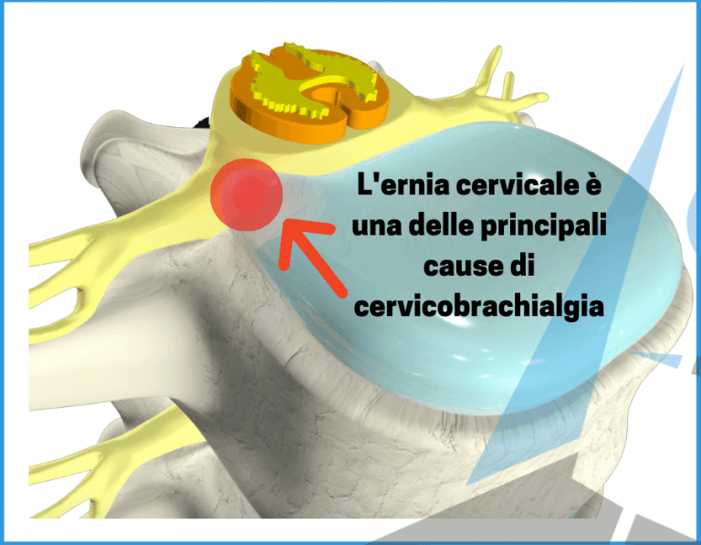 Ernia cervicale cervicobrachialgia