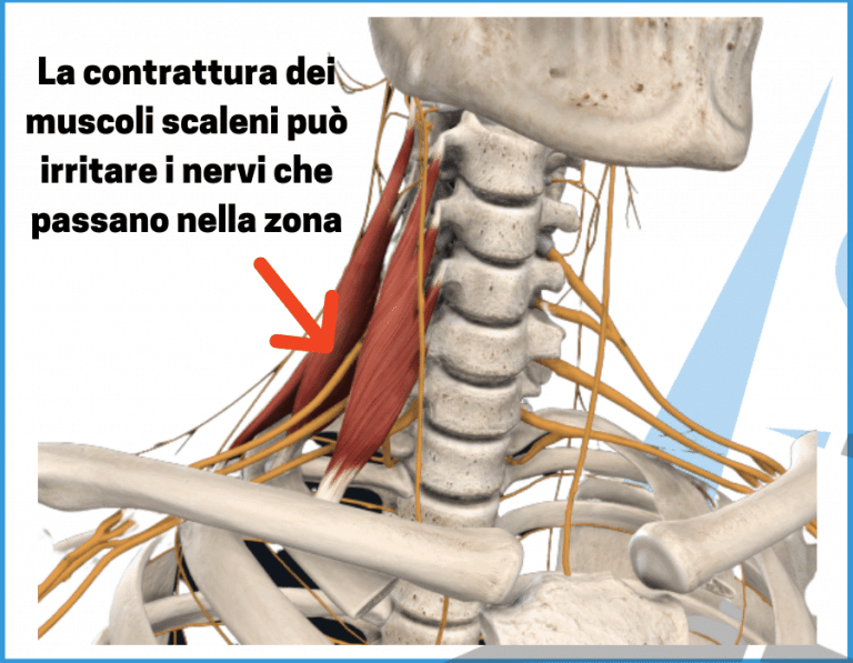 Cause cervicobrachialgia