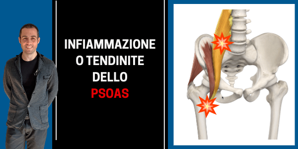 Infiammazione o tendinite dello PSOAS: ecco cosa fare