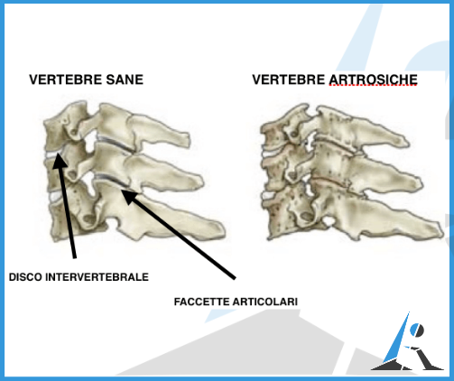 Artrosi cervicale