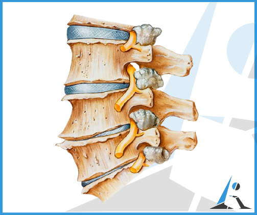 Artrosi Cervicale: Cura Definitiva Per Artrosi Cervicale