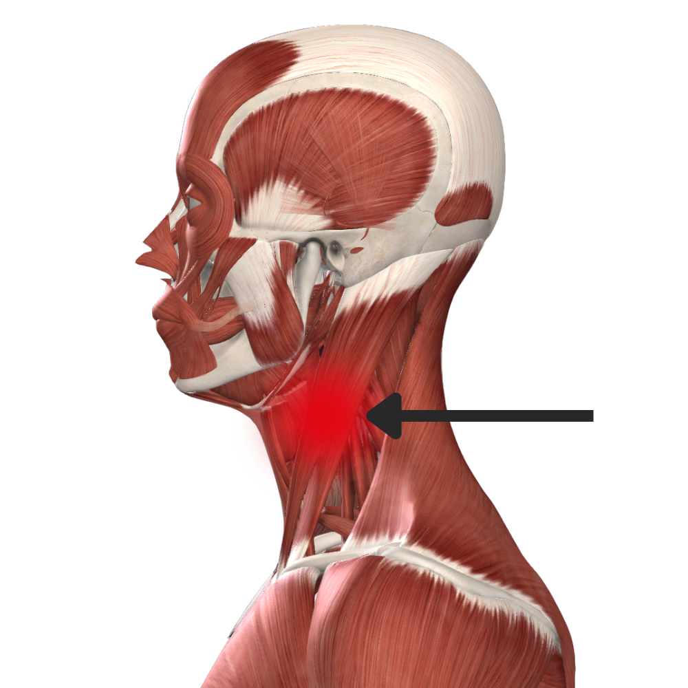 Dolore sternocleidomastoideo