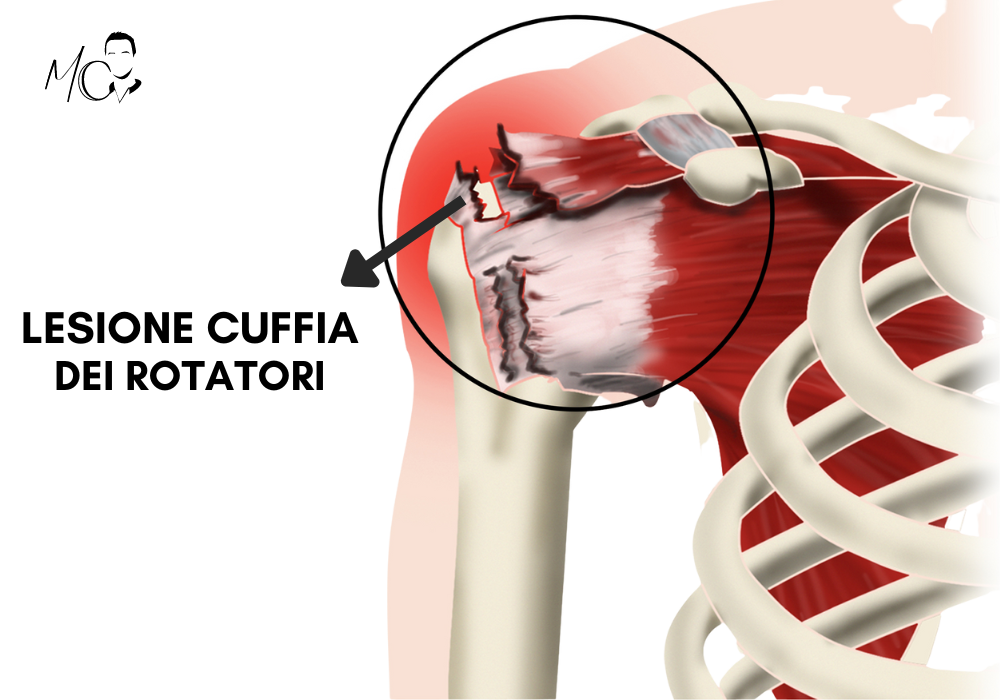lesione cuffia dei rotatori