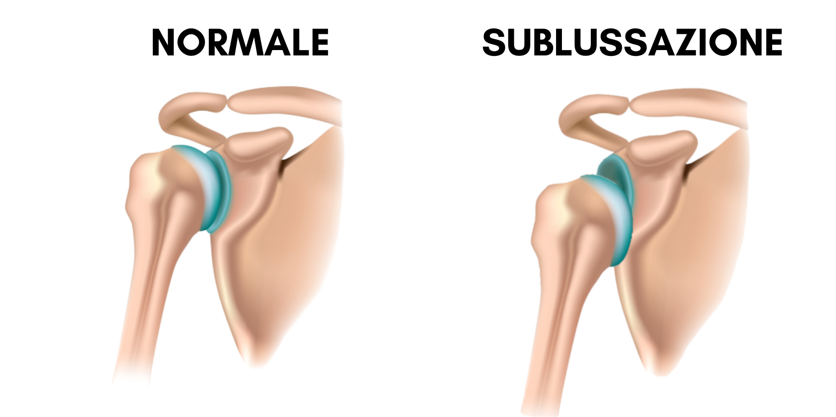 sublussazione della spalla