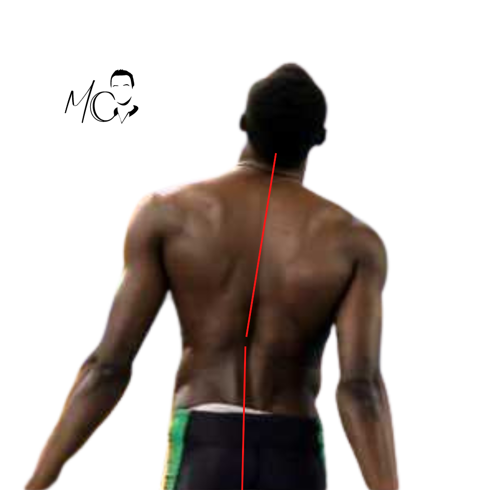Usain Bolt Scoliosi lombare