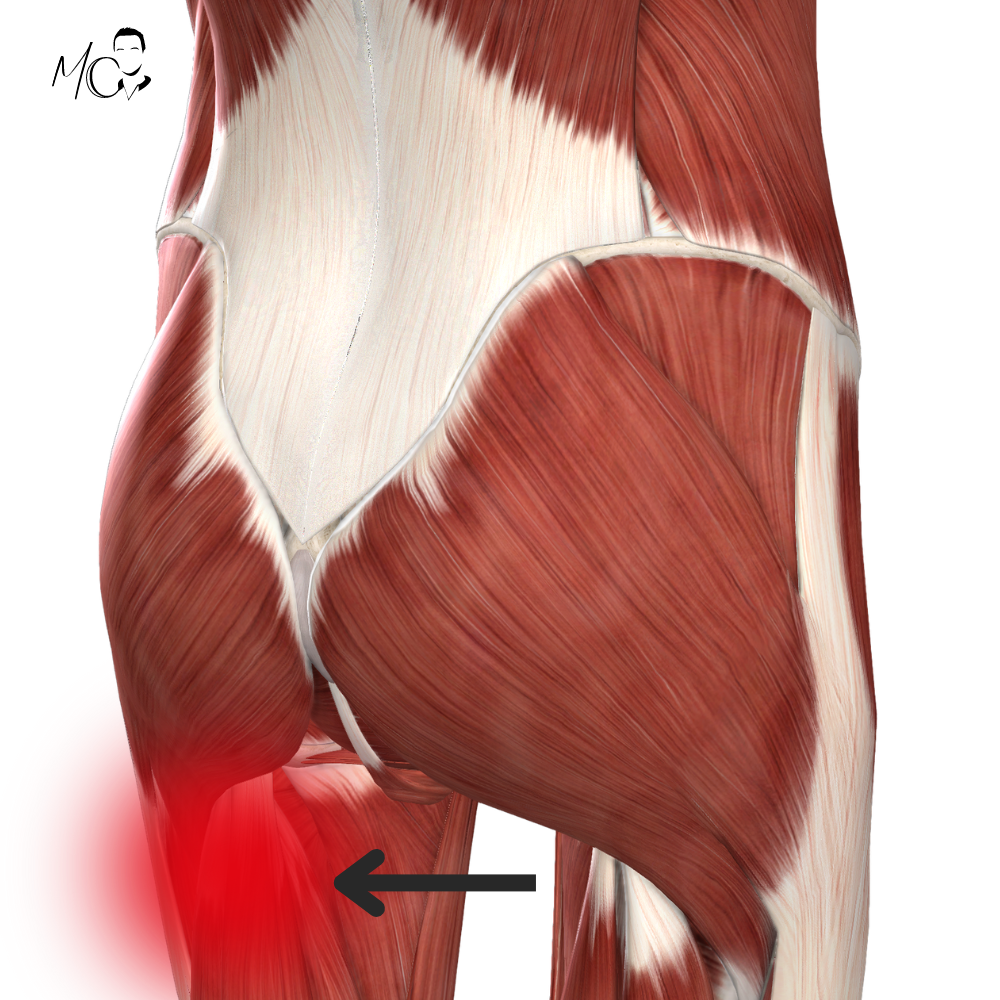 Dolore dietro la coscia sotto il gluteo