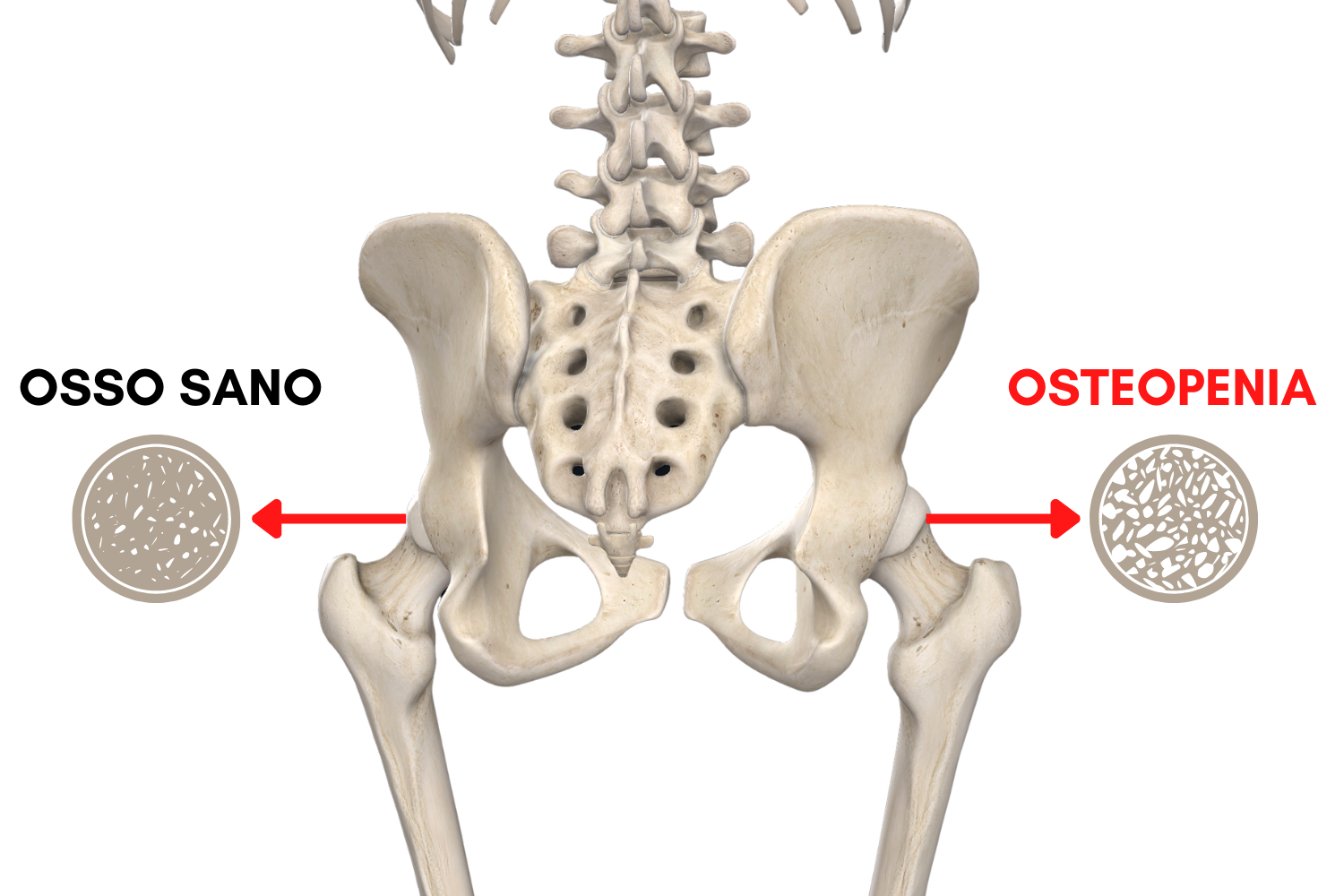 Osteopenia