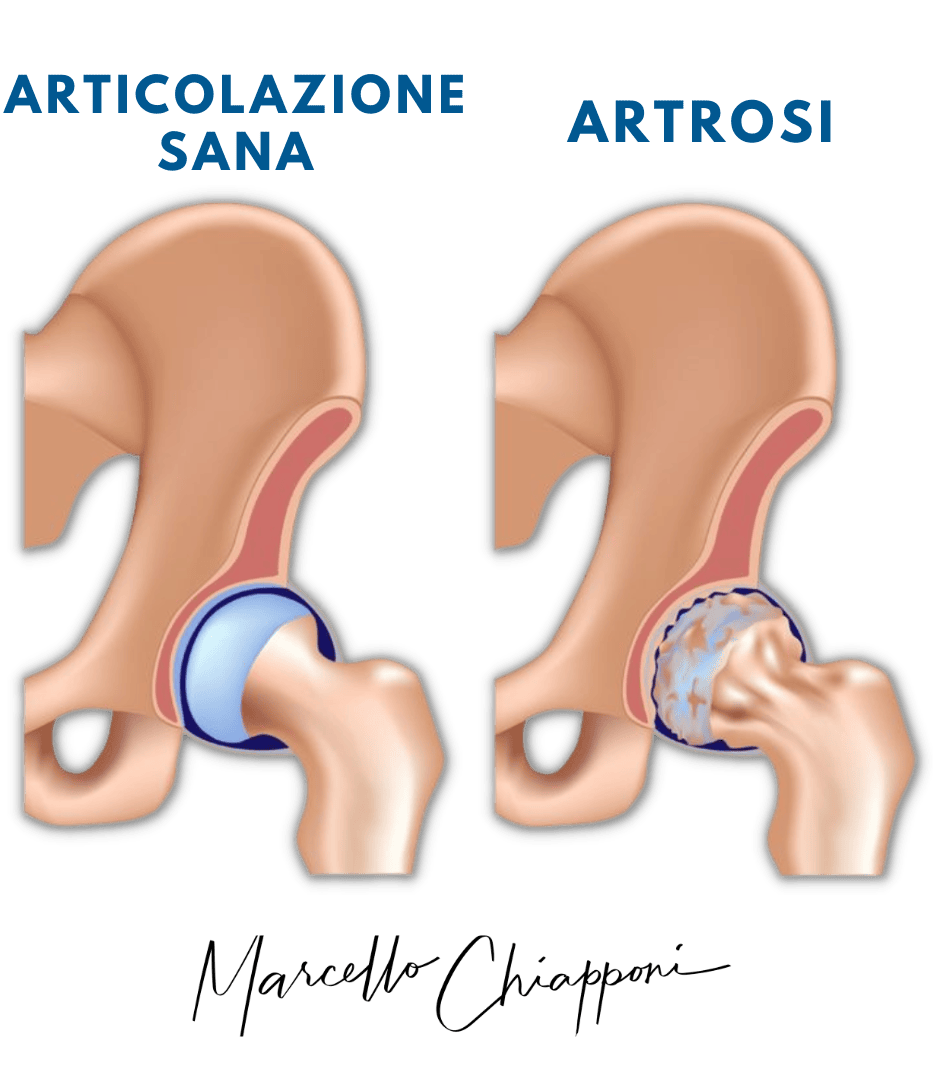 artrosi all'anca senza operazione