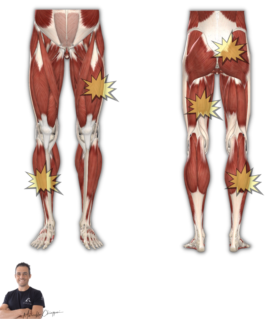 fibromialgia sintomi gambe