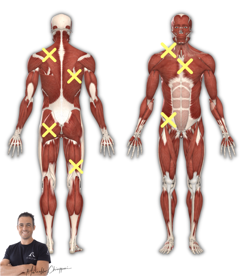 Fibromialgia punti dolenti