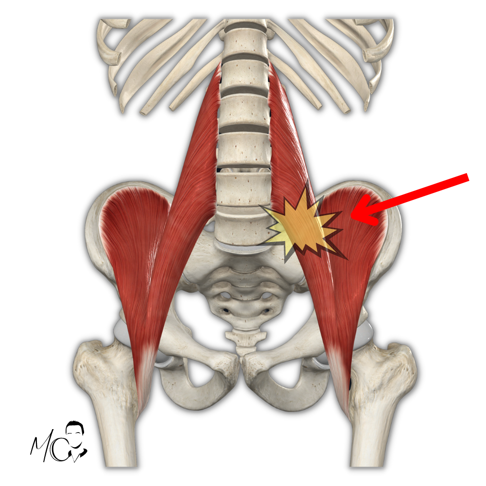 psoas e sciatica