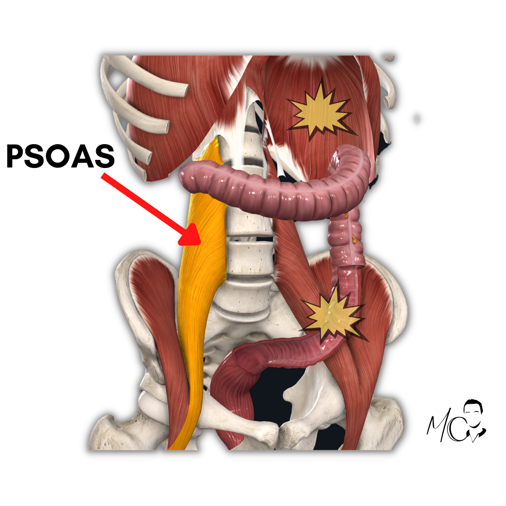 contrattura dello psoas