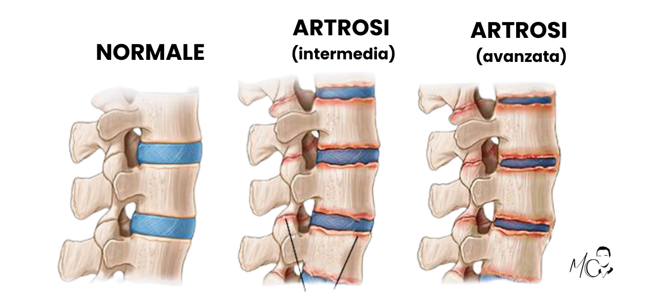 Artrosi cervicale