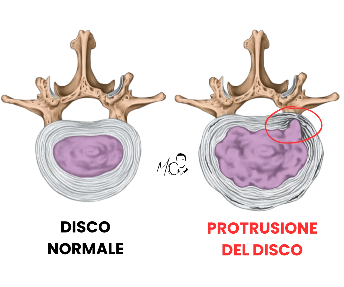 Protrusione cervicale